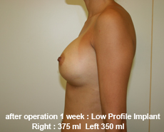 plastic-surgery-breast-augmentation